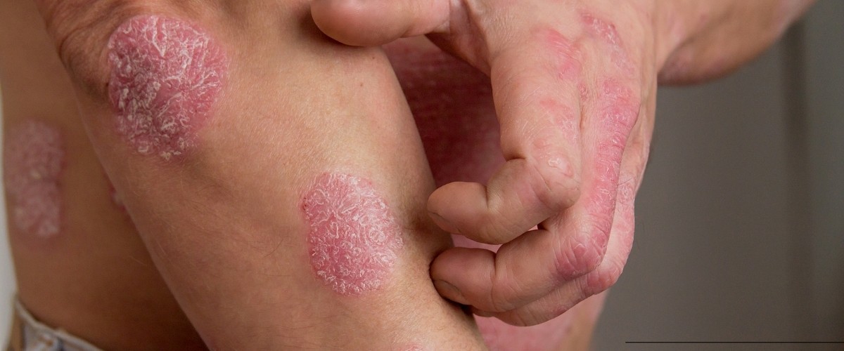 eczema and psoriasis management